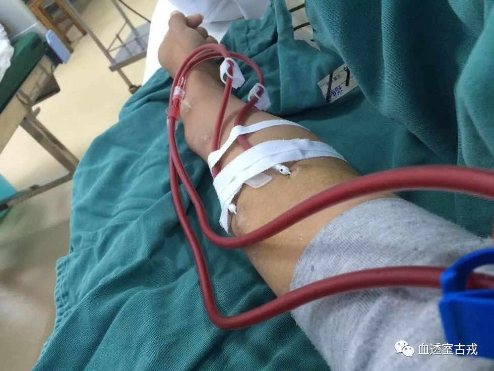 健康长久的透析是怎样的,健康人透析会怎么样