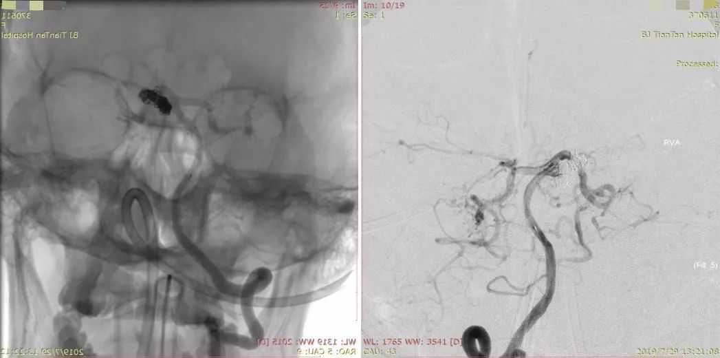 物华天宝·第12期｜复发多发动脉瘤合并烟雾病的支架辅助弹簧圈栓塞治疗