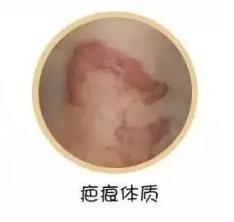 疤痕可以用纹身修复吗,疤痕体质可以用纹身去遮盖疤痕吗