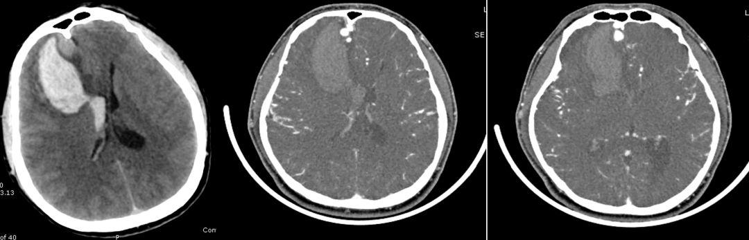矛盾反应、Carney综合征、脑梗死、笑气中毒丨3分钟读片·第19期