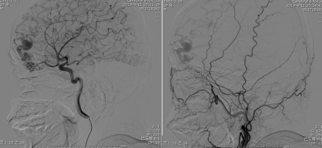 矛盾反应、Carney综合征、脑梗死、笑气中毒丨3分钟读片·第19期