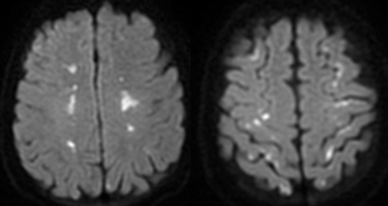 矛盾反应、Carney综合征、脑梗死、笑气中毒丨3分钟读片·第19期