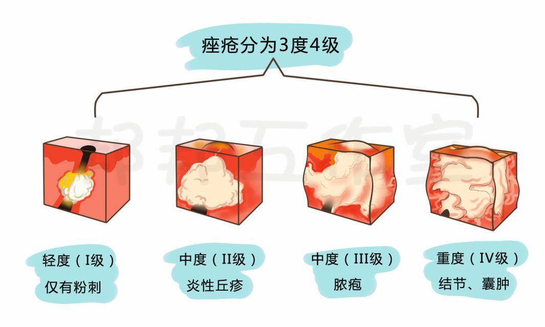 长黑头粉刺该怎么快速去除,鼻子上的黑头特别多该怎么去除