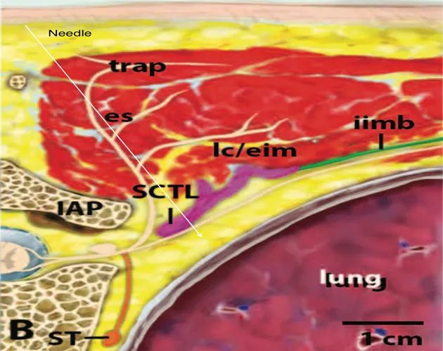 胸椎旁神经阻滞时需要穿过的韧带,胸椎旁神经阻滞超声探头位置