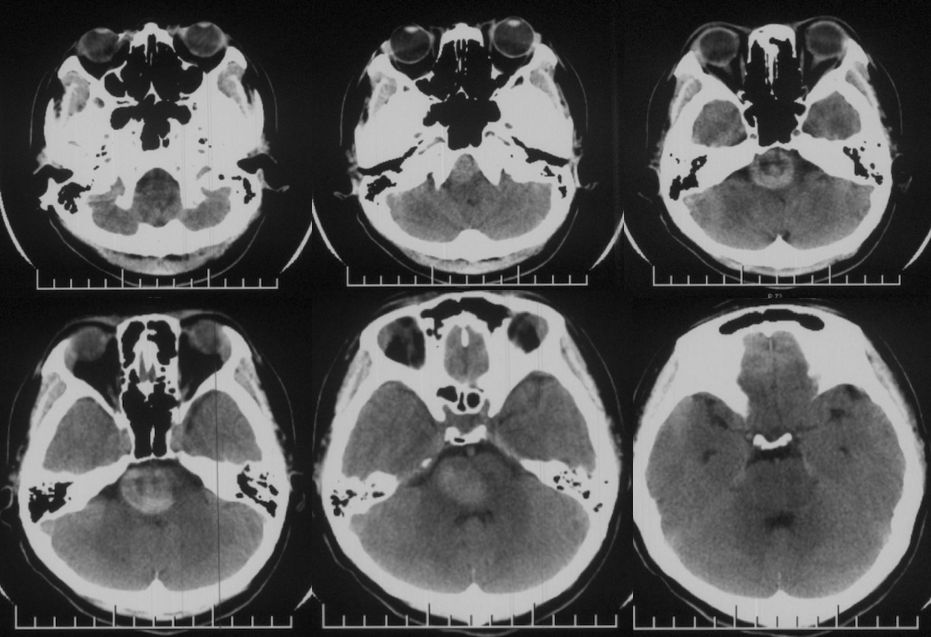 穆如清风·第13期｜Tubridge治疗基底动脉巨大夹层动脉瘤