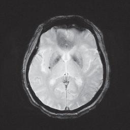 王拥军讲心脑血管病,王拥军讲血栓视频