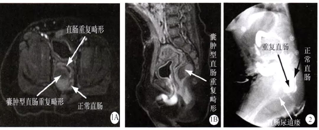 肠重复畸形严重吗,宝宝肠重复畸形怎么治疗