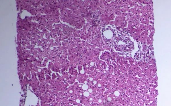 alp和ggt偏高是什么意思,alp和ggt下降意味着什么