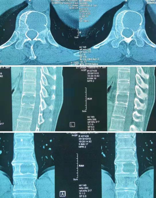 胸椎瘤手术,胸椎旁肿瘤手术成功率