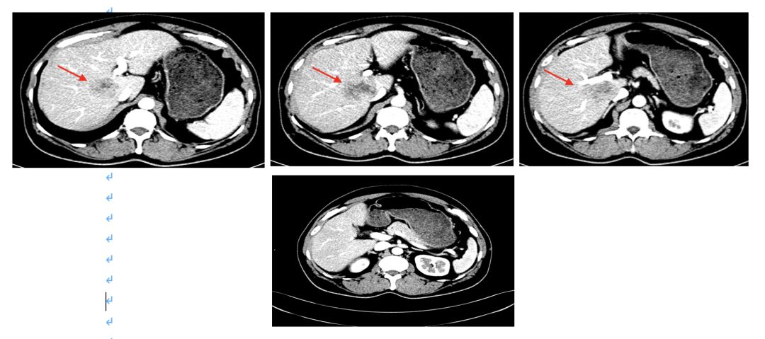 升结肠癌肝转移，如何实现治愈“神话”？|病例分享