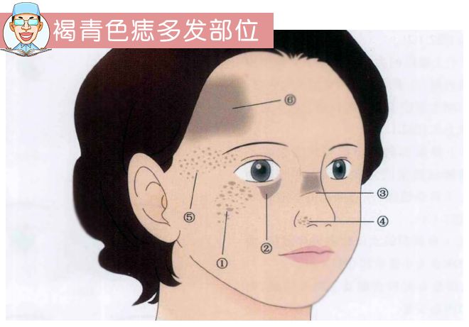 褐青色痣和斑的区别,褐青色痣斑是怎么形成的