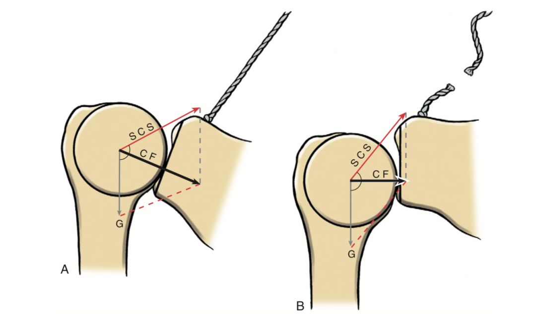 如何矫正耸肩的动作,做动作总是斜方肌代偿