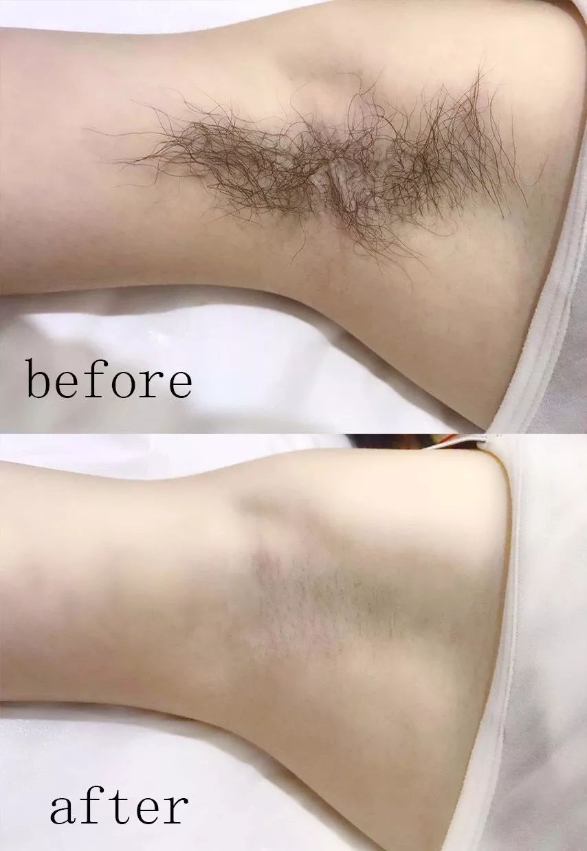 永久脱毛膏既好用又便宜,脱毛膏好用还是刮毛刀好用呢