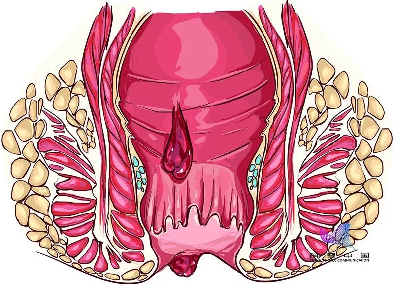 不敢相信,“十人九痔”,竟与这习惯有关!很多人不知道