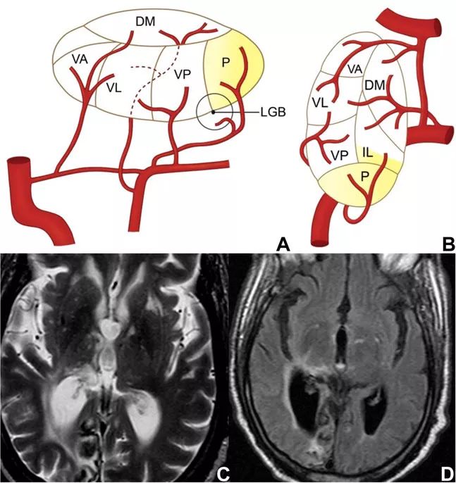 脑梗死的分类及ct影像学表现,丘脑梗死的临床表现
