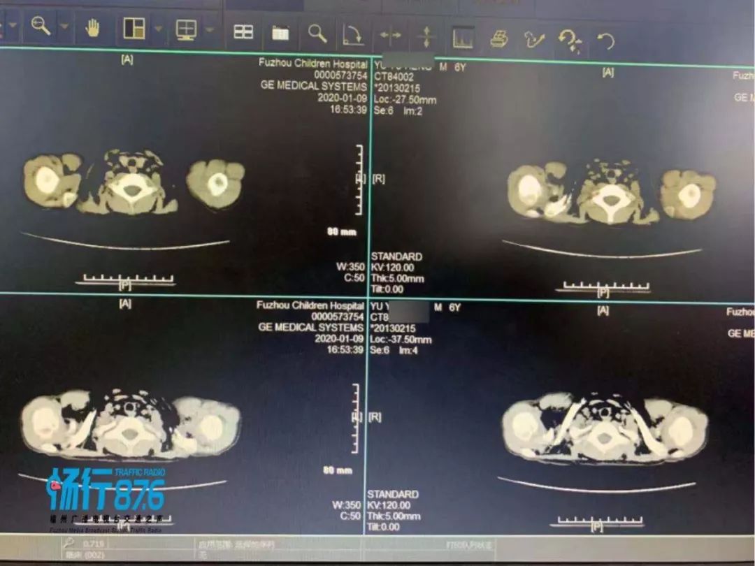 福州一男童上半身充斥气泡，作为家长，值得警醒