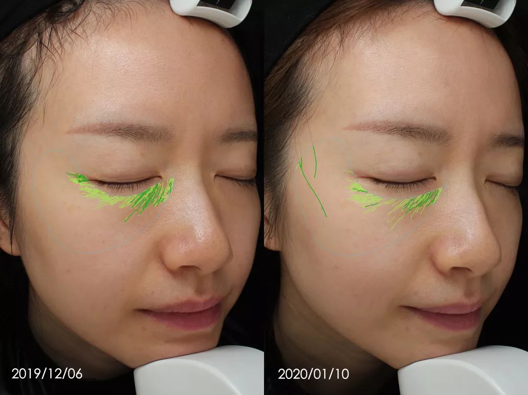 抗老三部曲紧致少女肌,抗老做好这五步hold住童颜少女肌