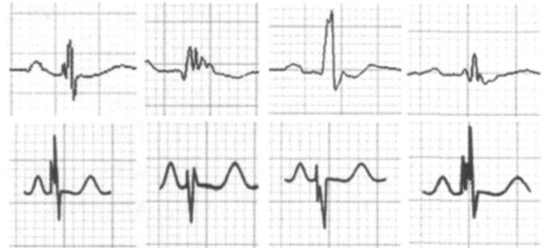 单纯心电图能判断心肌梗死吗,心电图判断冠心病准确吗