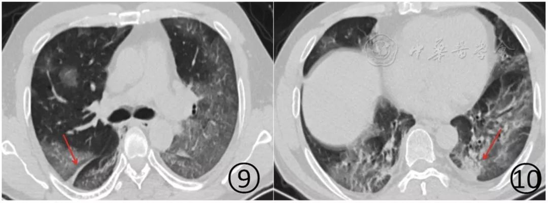 新冠肺炎影像演变过程,新冠肺炎胸部影像学特点有哪些