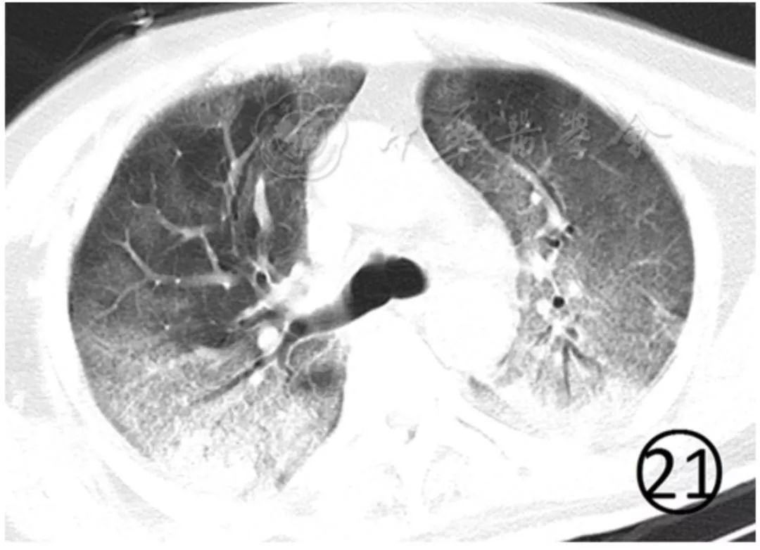 新冠肺炎影像演变过程,新冠肺炎胸部影像学特点有哪些