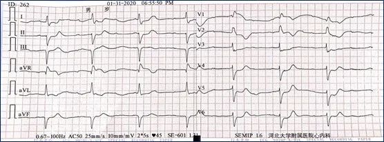 病例丨“一波三折”的三度房室传导阻滞，原因何在？