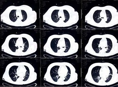 病例丨“一波三折”的三度房室传导阻滞，原因何在？