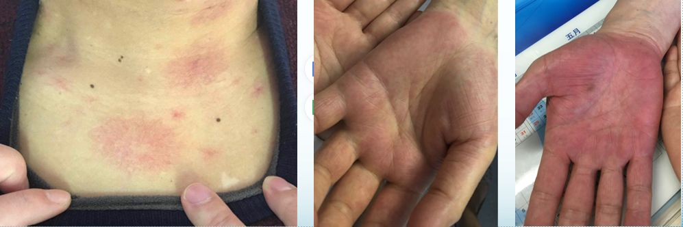 肝硬化肝肺综合征一般活多久,肝性脑病是肝硬化最严重的并发症