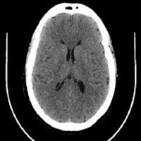 延髓外侧综合征口诀,延髓背外侧综合征典型病例