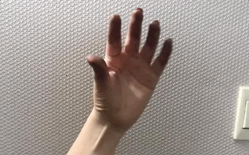 戴口罩闷痘怎么办？皮肤科专家教你7步祛痘*法大**