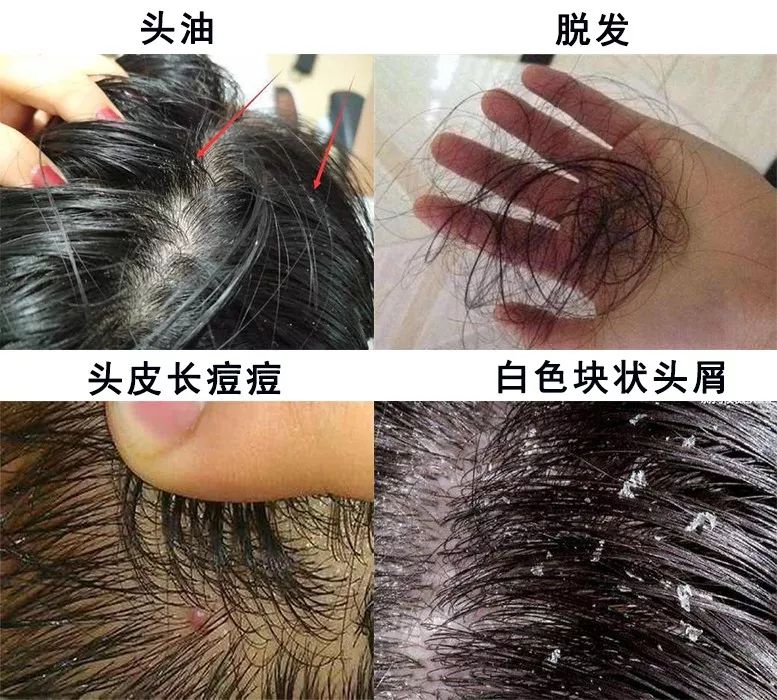 头上又油又有头皮屑又痒怎么办,头上又痒又油有头屑