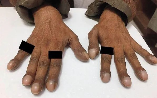 NEJM病例:肝肺综合征一例