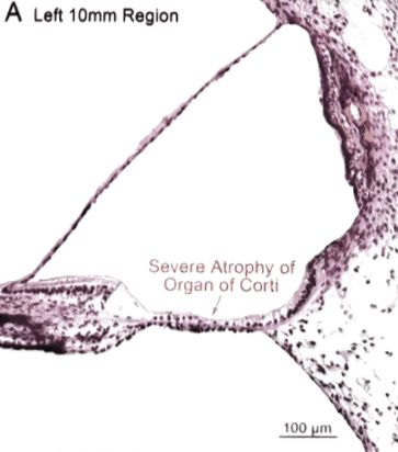 梅尼埃病深度解析,梅尼埃病病理解剖