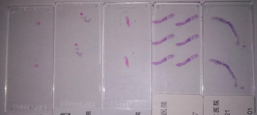 2020年淋巴瘤病理诊断必备知识点,淋巴瘤病理质控