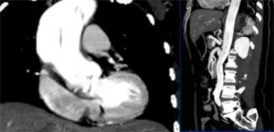 主动脉夹层真假腔鉴别超声示意图,主动脉夹层诊断中国专家共识