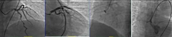 主动脉夹层真假腔鉴别超声示意图,主动脉夹层诊断中国专家共识