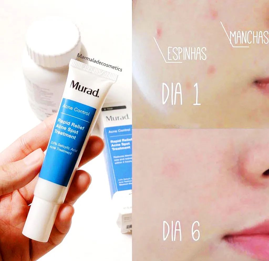 为什么戴上口罩会闷痘,为什么戴口罩就长痘