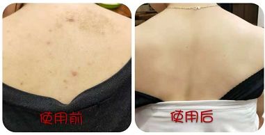 前胸鸡皮痘痘怎么处理,胸背痘痘清理