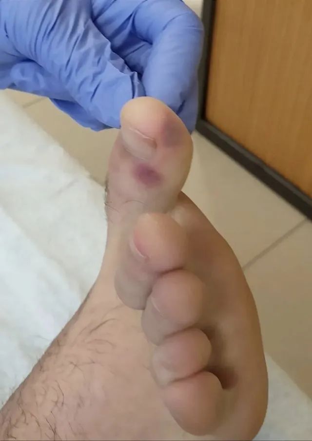 脚上常见的长痘疾病,医生诊断出脚上长痘痘