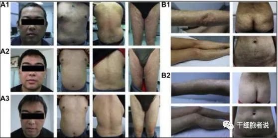 间充质干细胞治疗银屑病最新消息,间充质干细胞与类风湿性关节炎