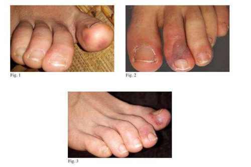 脚趾甲盖紫色是新冠后遗症吗,新冠脚趾变紫怎么回事