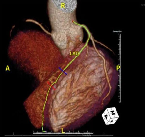 血糖30多也没发生酮症酸中毒,血糖高胸痛是什么病变