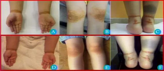 多发性黄色瘤,胆固醇高引起的黄色瘤是什么样的