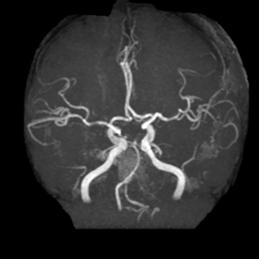 左侧大脑后动脉开窗畸形图片,脑部基底动脉开窗畸形如何治疗