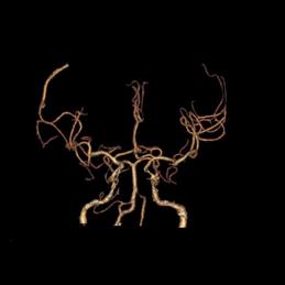 左侧大脑后动脉开窗畸形图片,脑部基底动脉开窗畸形如何治疗