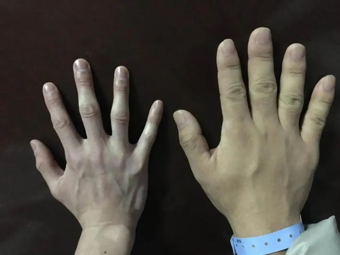 肢端肥大症怎么检测,儿童肢端肥大症图片