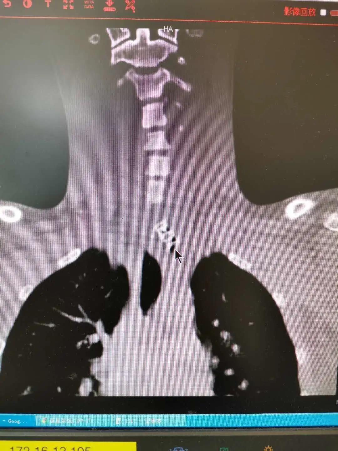 天呐,老人喝粥老是噎住