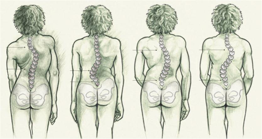 健康科普|甘肃省中医院小儿骨二科开展青少年脊柱侧弯矫形相关项目