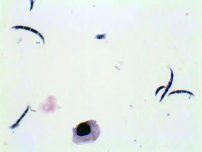 尿液中的有形成分红细胞,尿液中常见的有形成分