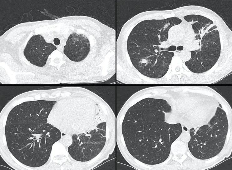 肺炎患者抢救记录,新冠肺炎危重症患者抢救成功案例