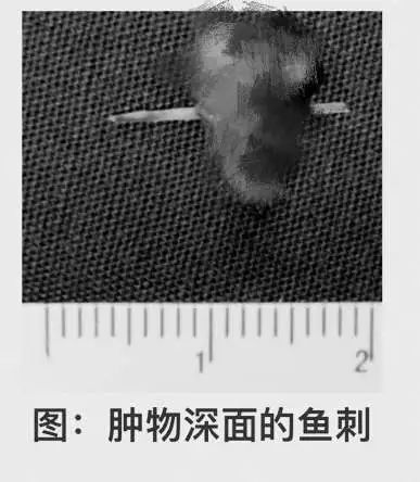 舌头溃烂患舌癌,舌头溃烂医生说危险就是舌癌了吗